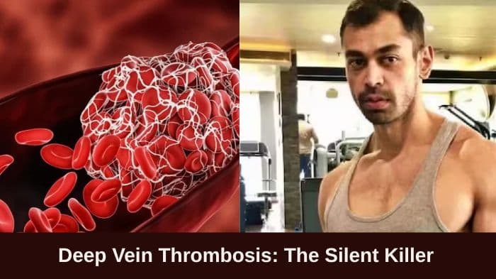 What is Deep Vein Thrombosis (DVT)? The condition linked to Prateek Yadav’s sudden death